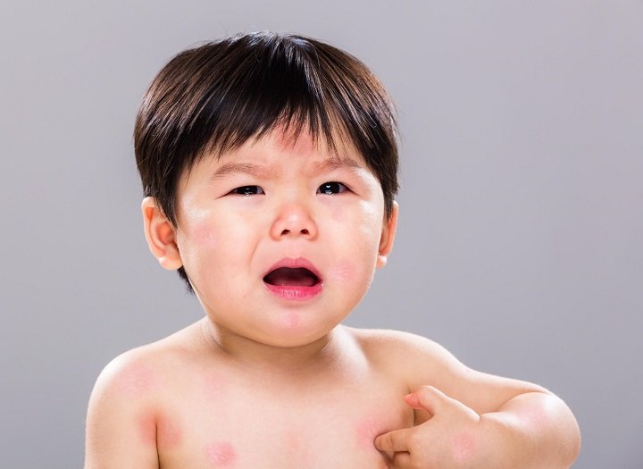 Dấu hiệu bé bị dị ứng thịt lợn khi ăn cháo và cách xử lý
